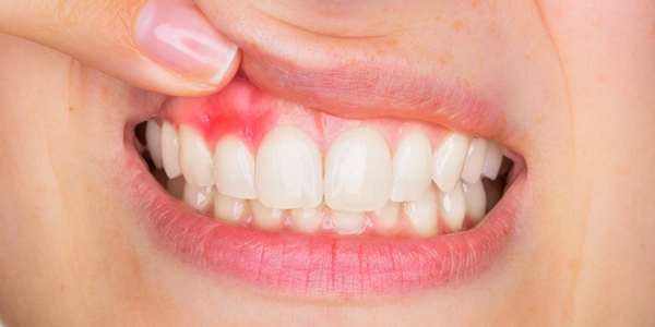 Image of woman's teeth and gums
